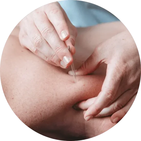 dry-needling-large-square